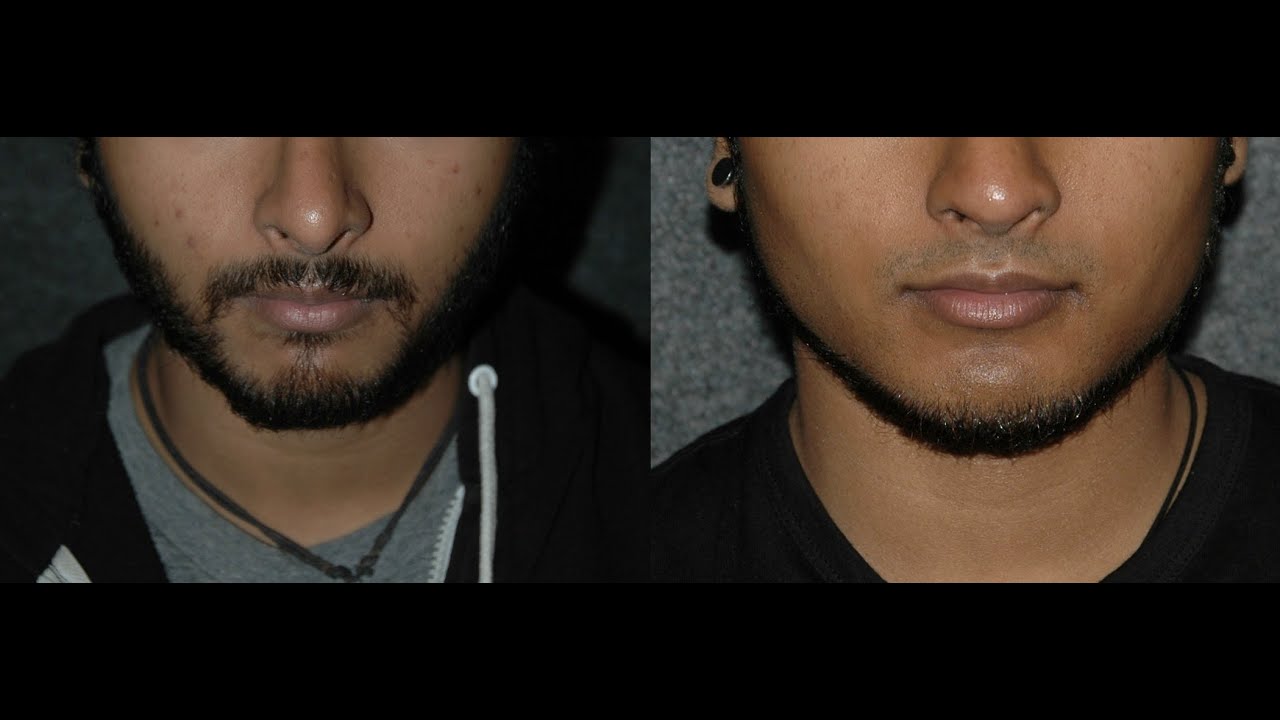 Jaw Implant Surgery New York | Jaw Implants NYC