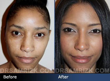 Hispanic Rhinoplasty, Spanish Nose Job Surgery NYC