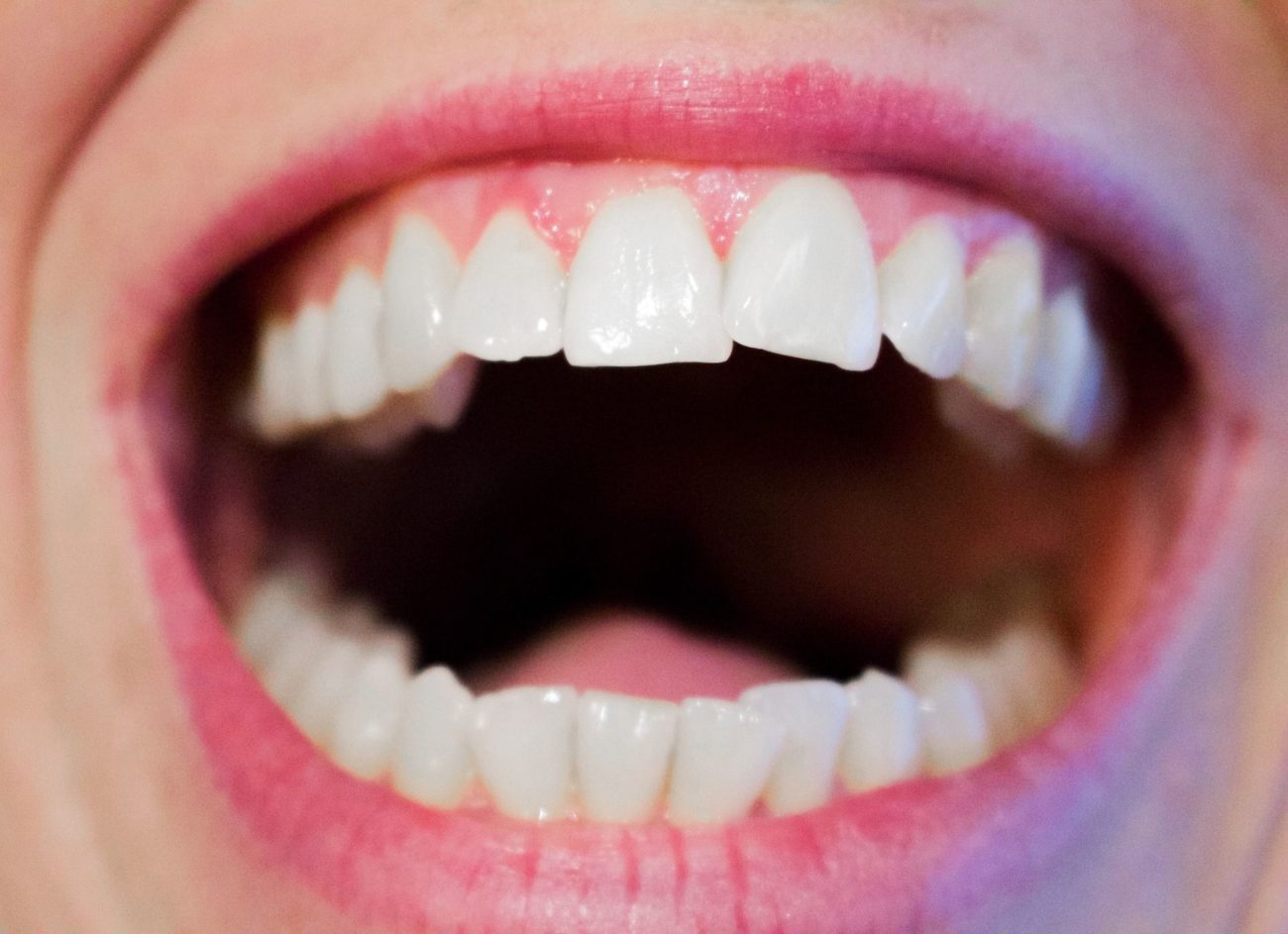 Why Are Crooked Teeth More Than A Cosmetic Issue? | Palmetto Smiles