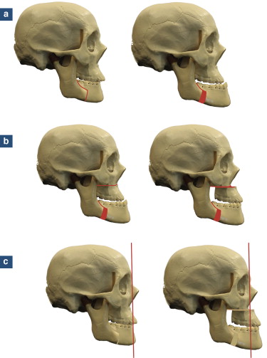 Bi-maxillary advancement surgery: Technique, indications and results -  ScienceDirect