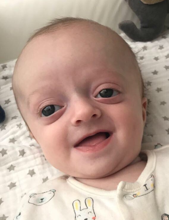 Baby_with_Crouzon_Syndrome.jpg