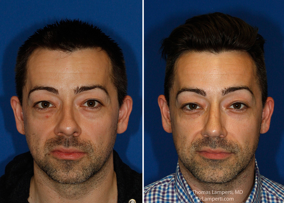 rhinoplasty-52-frontal-montage.jpg