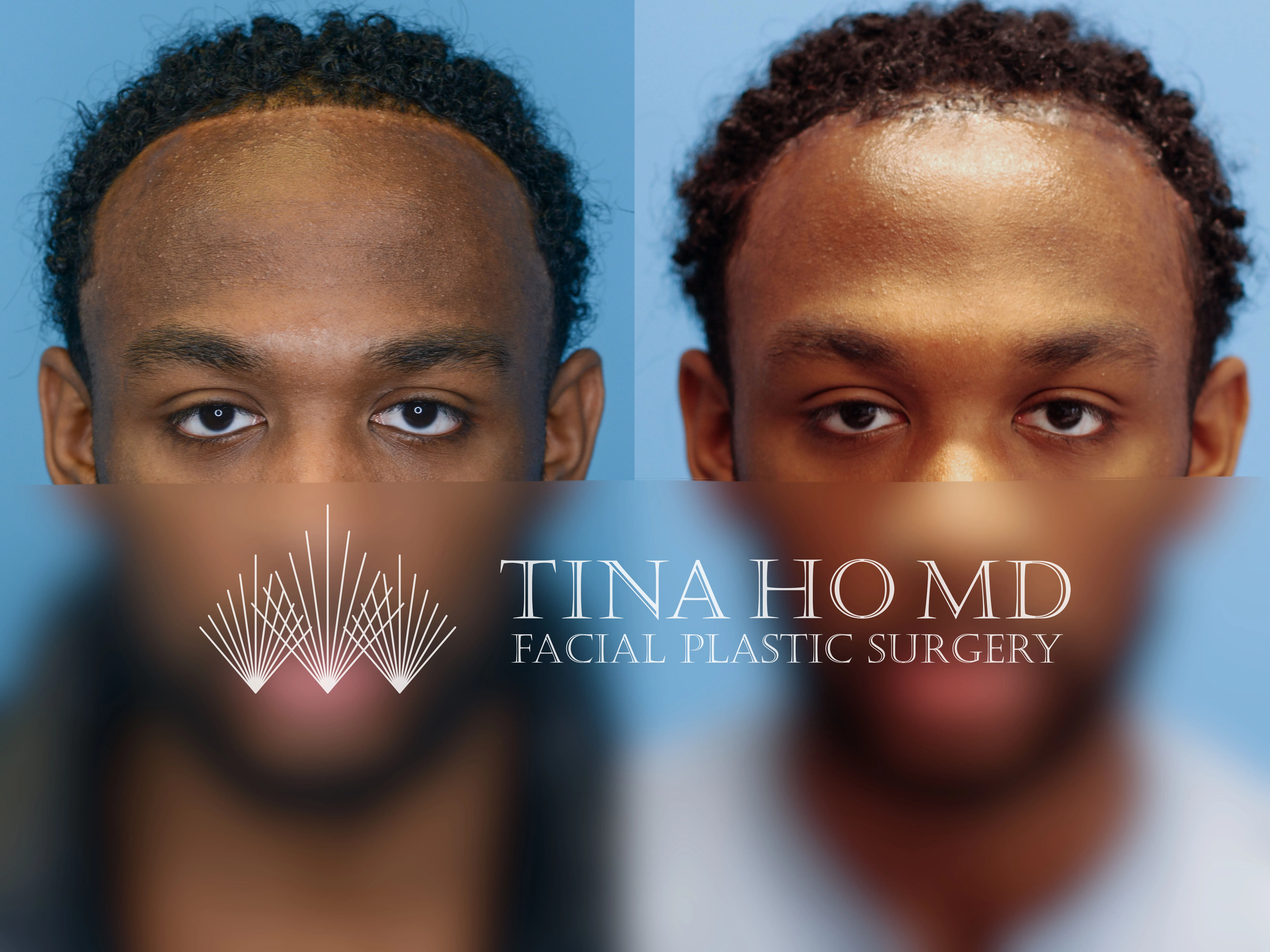 Forehead Reduction Surgery In Philadelphia | Hairline Lowering Surgery