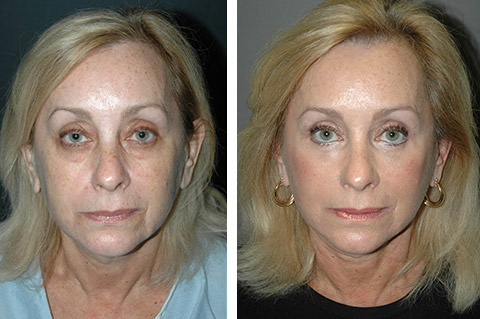 SMAS Facelift | Best SMAS Facelift Surgeon | SMAS Face Lift