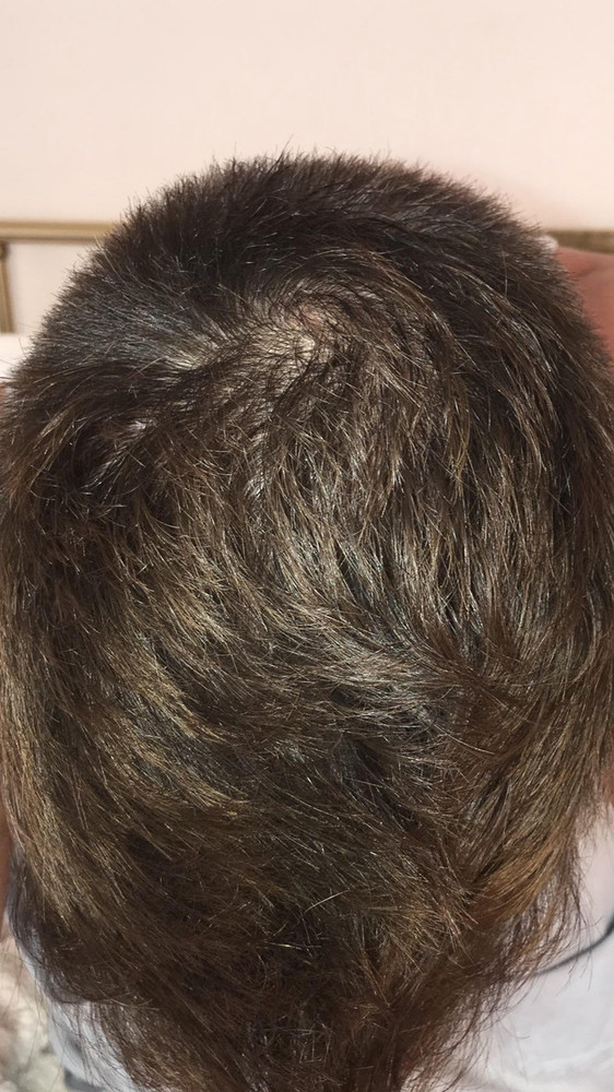 4-months-topical-dutasteride-jpg.140046