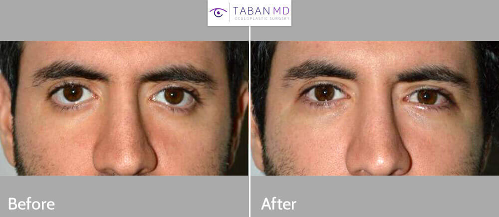 eyelid-retraction-repair-surgeon-1.jpg