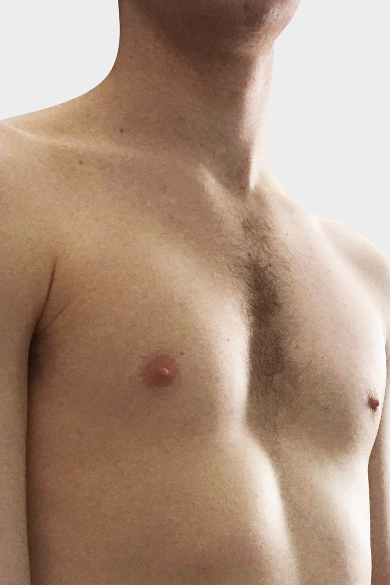 PectusExcavatum-img-4.jpg