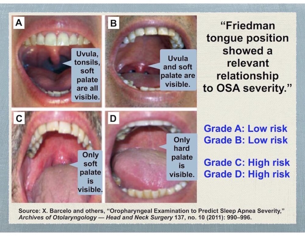 Friedman tounge position 1024x791