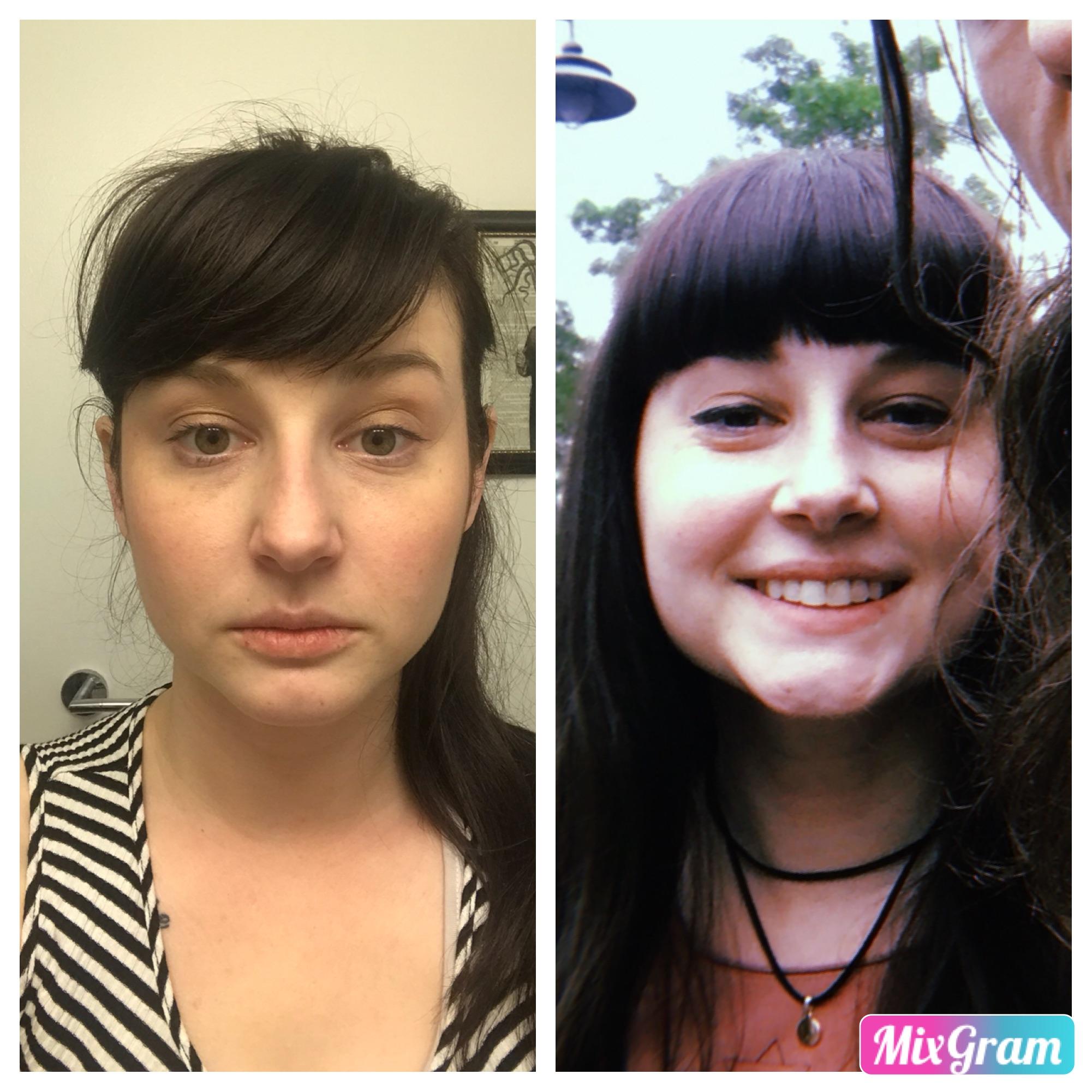 Embracing my new moon face. Day 1 of prednisone vs. Day 21. : CrohnsDisease