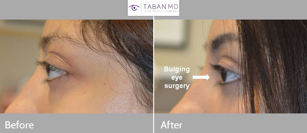 Young beautiful woman with genetic prominent bulging eyes underwent scarless cosmetic orbital decompression surgery.