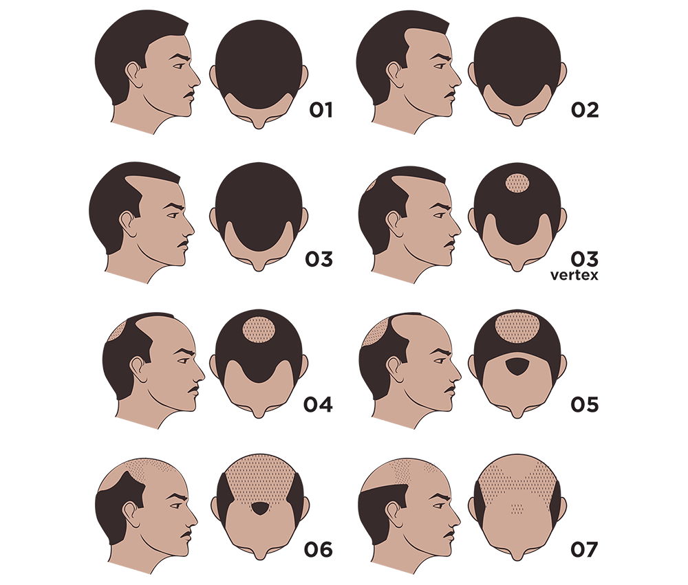 norwood-scale-nw2.png