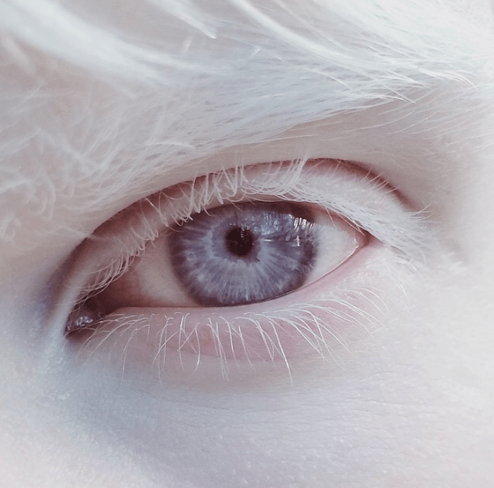 What-Is-Albinism1447838947.png