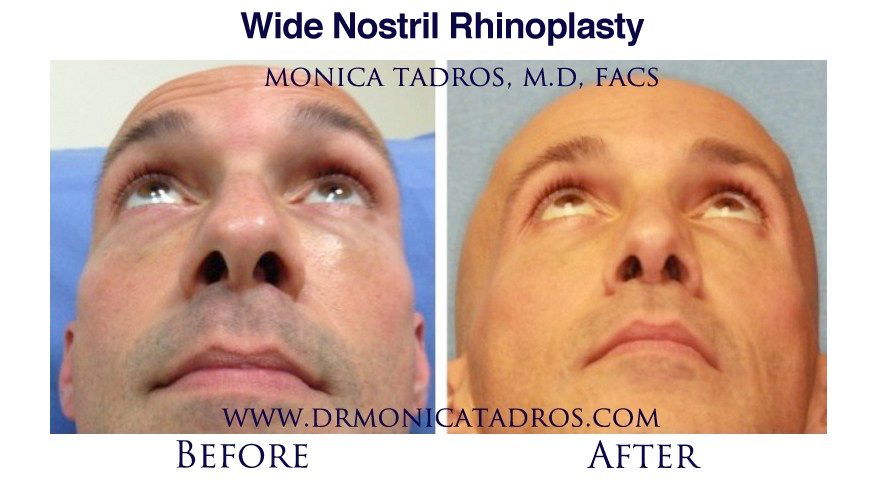 wide-big-nostril-surgery-Englewood-Bergen-County-NJ.jpg