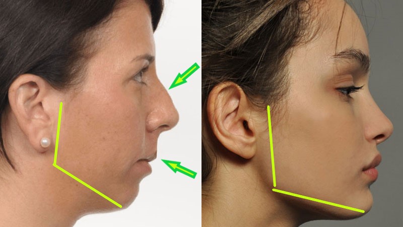 recessed_vs_forward_faces.jpg