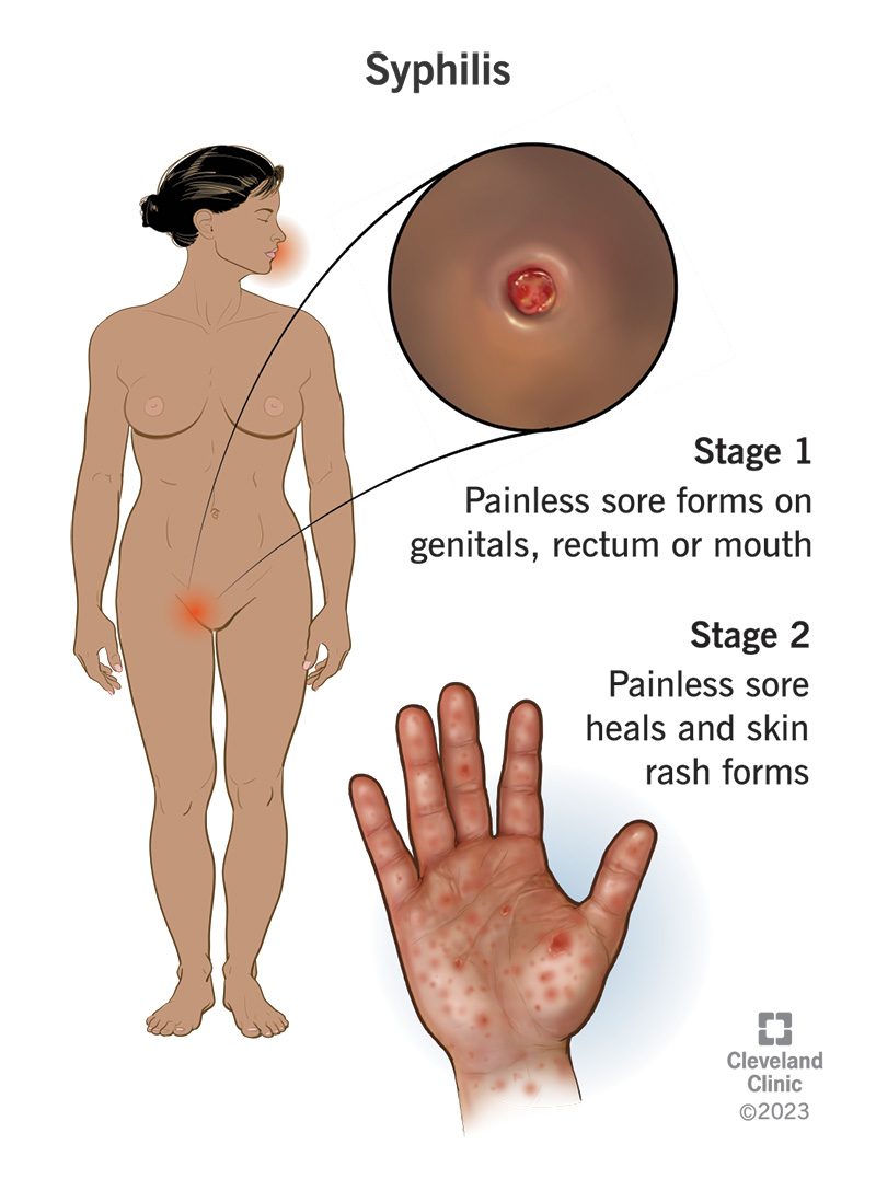 4622-syphilis