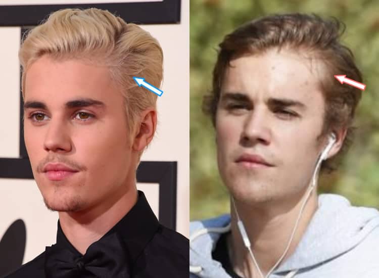 justin-bieber-hair-loss.jpg