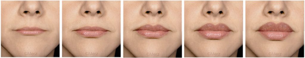 Upper-Lip-Scale-1-5-1024x197.jpg