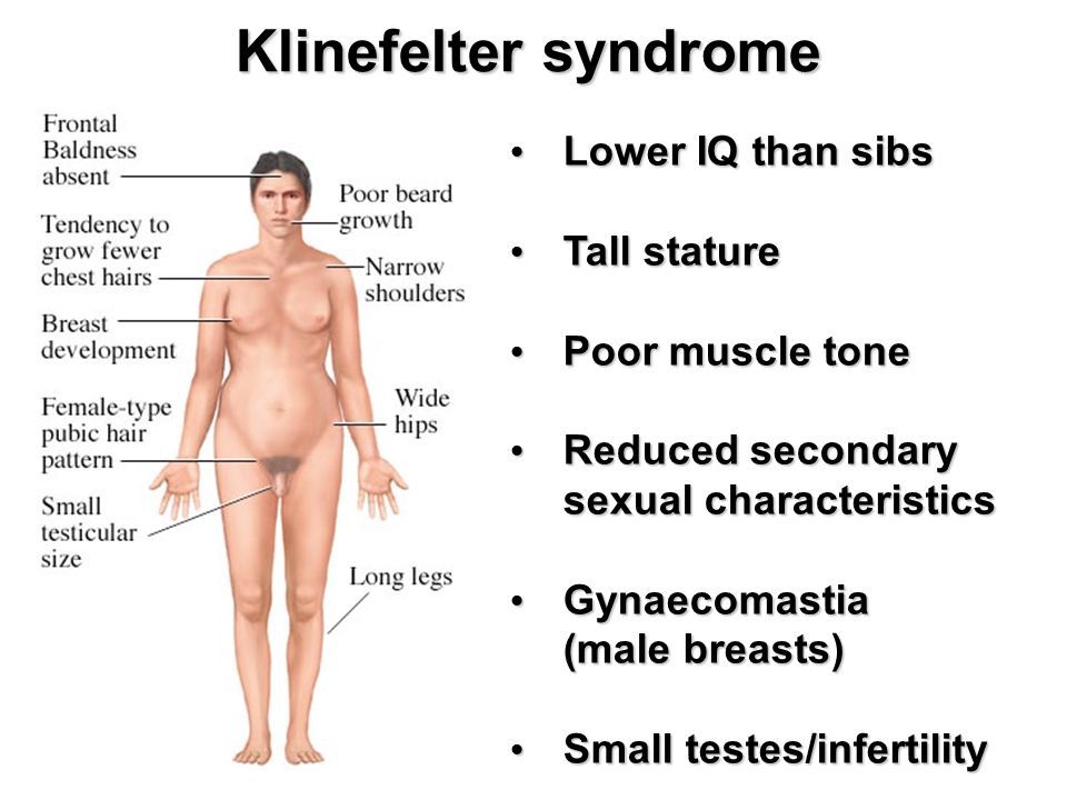 symptoms-of-Klinefelter-syndrome.jpg
