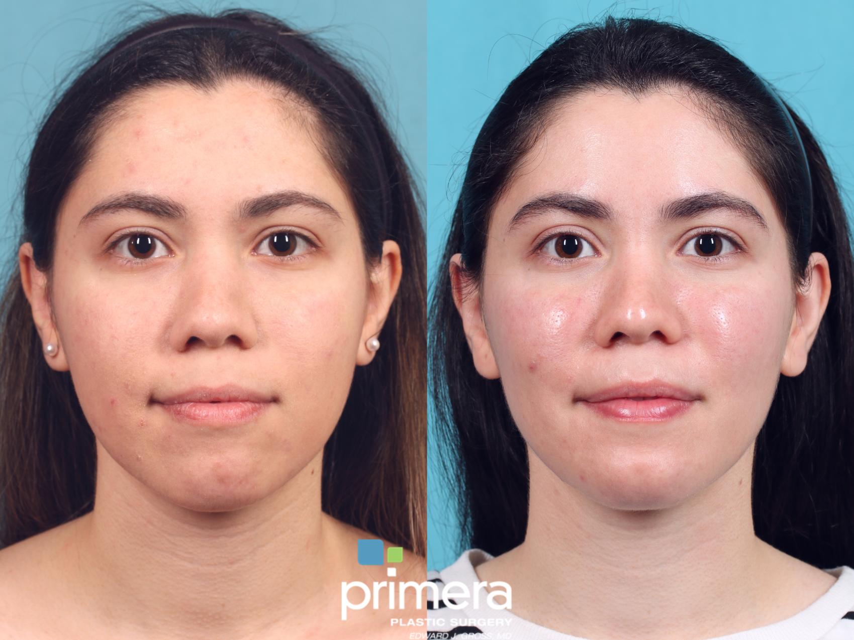 buccal-fat-removal-598-front-detail.jpg