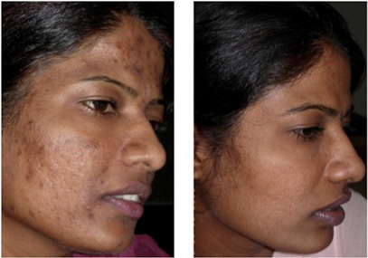 hyperpigmentation1.jpg