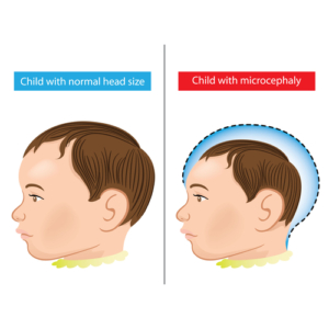 Microcephaly-newborn-300x300.jpg
