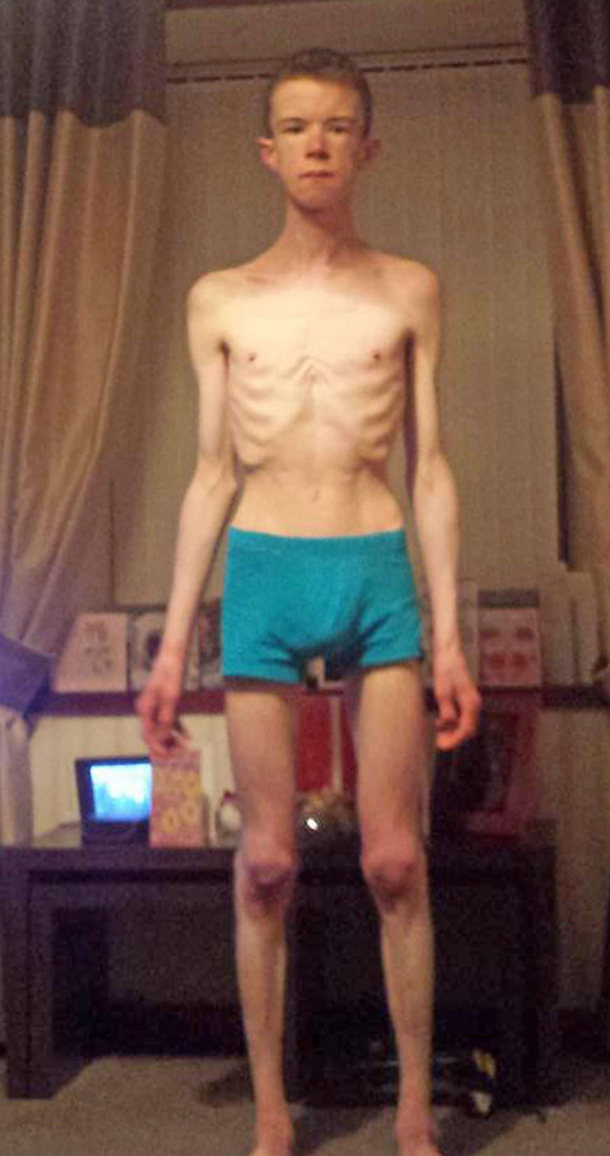 Anorexic male student who was 'close to death' after surviving on 1,200  calories a day says binge-watching Great British Bake Off saved his life