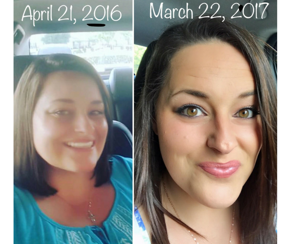 Image result for hypothyroid moon face