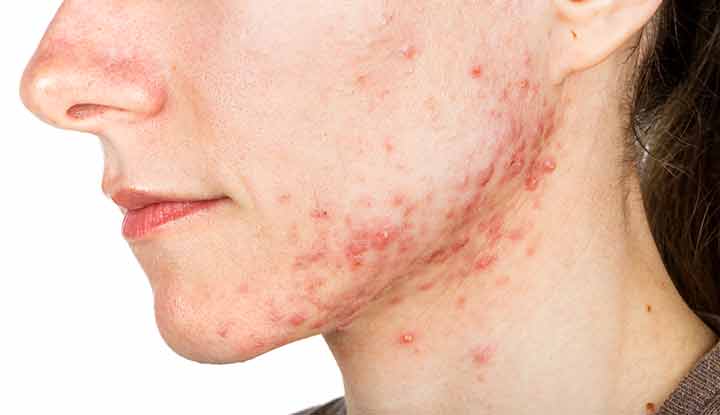 21737-cystic-acne-694069284