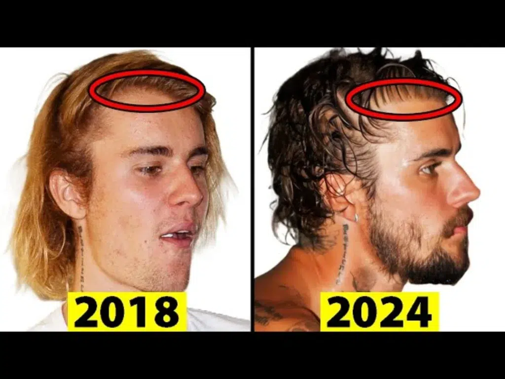 justin-bieber-hair-transplant-1024x768.webp