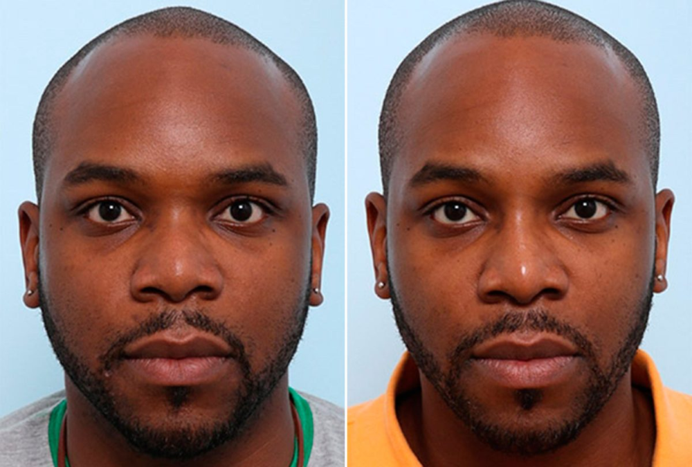 Buccal Fat Pad Removal