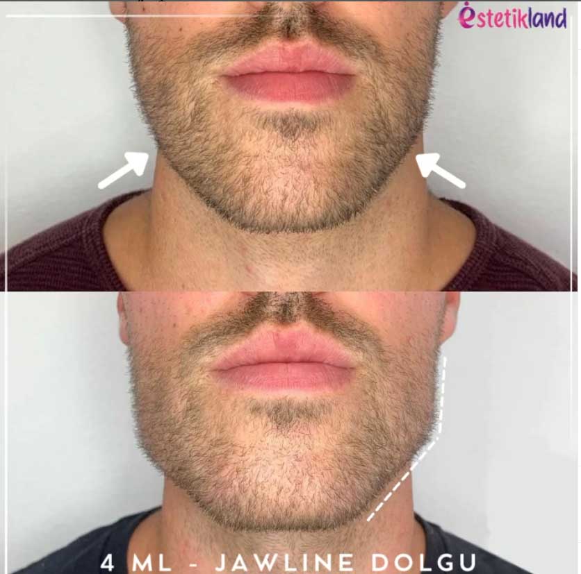 Jawline.jpg