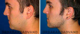 necklift-thumb-04.jpg
