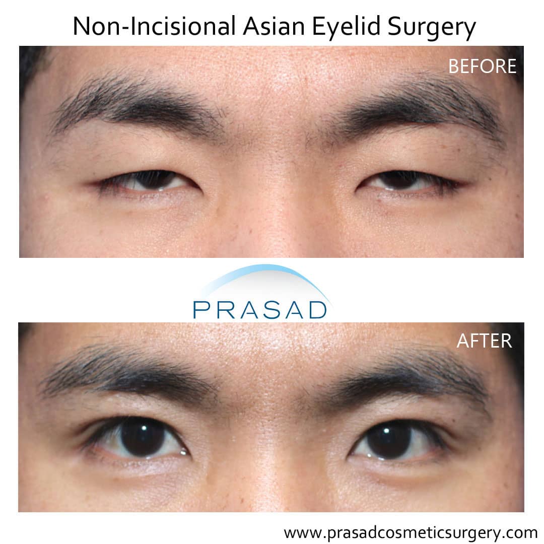 nonincisional-Asian-eyelid-surgery-before-and-after-1.jpg