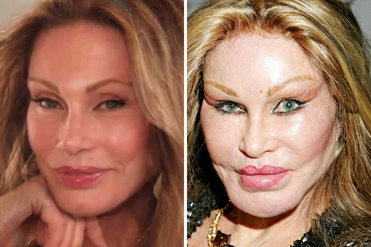 plastic-surgery-gone-wrong-3.jpg