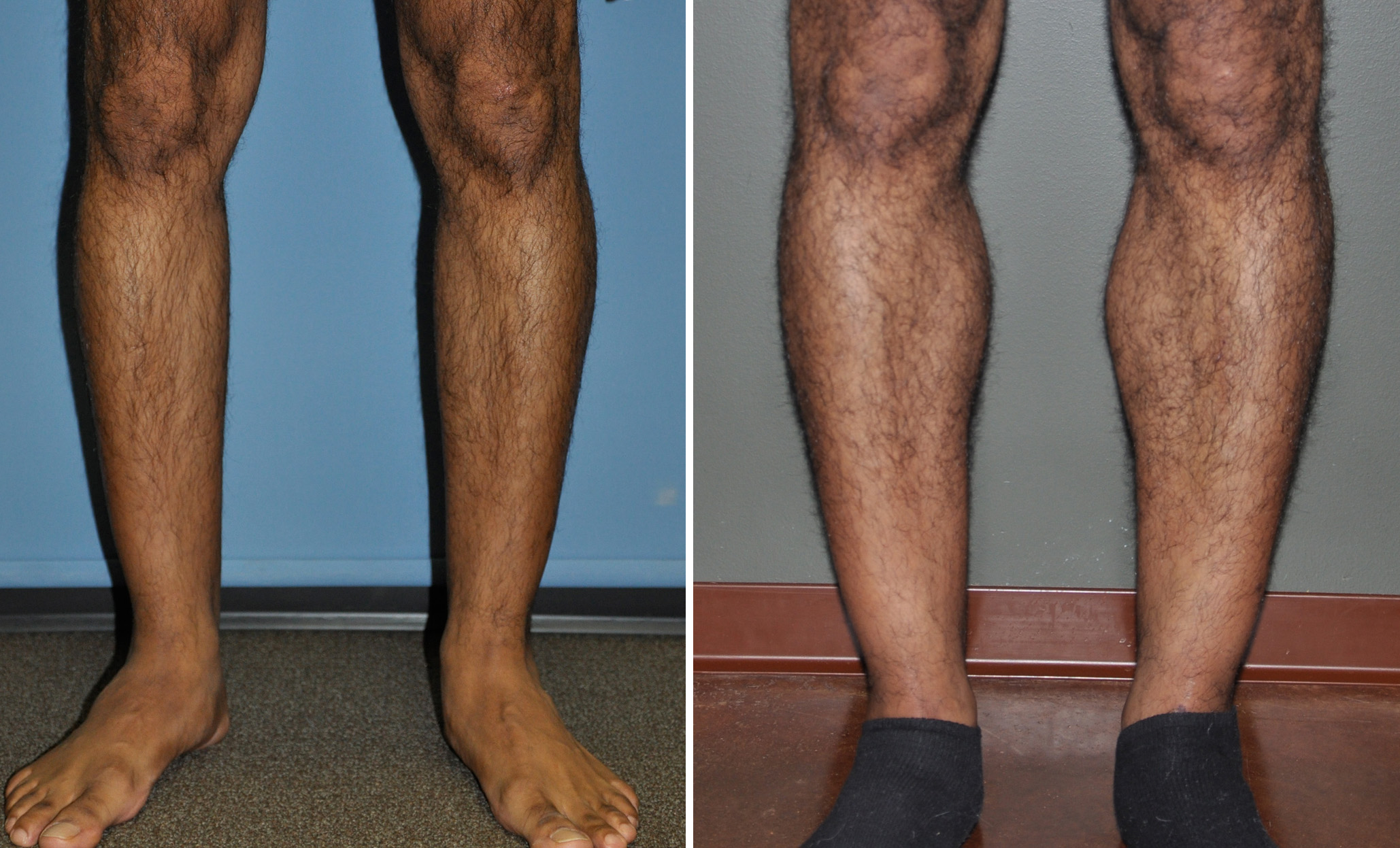 Calf-Implants-result-Dr-Barry-Eppley-Indianapolis.jpg