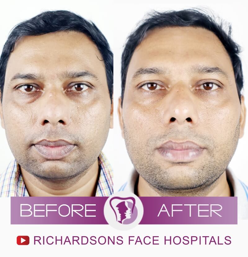 3789895_Sandip-Lip-Reduction-Surgery.jpg