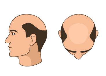 norwood-scale-stage-7.png