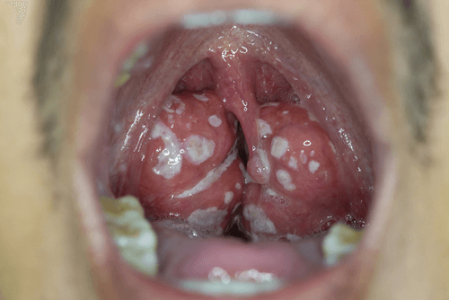 Tonsil Stones - Facts, overview, causes, treatment, and prevention | FactDr