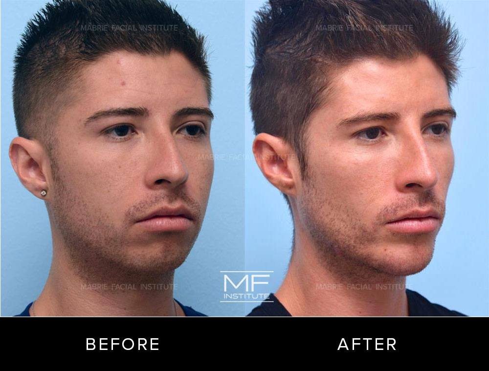 DCM-Before-After-496.jpg