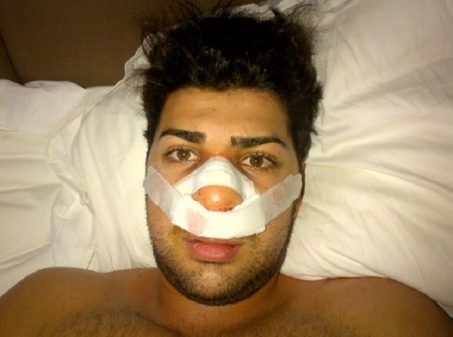 https://globalnews.ca/wp-content/uploads/2023/11/Alkhalil-nose-surgery.jpg?quality=85&strip=all