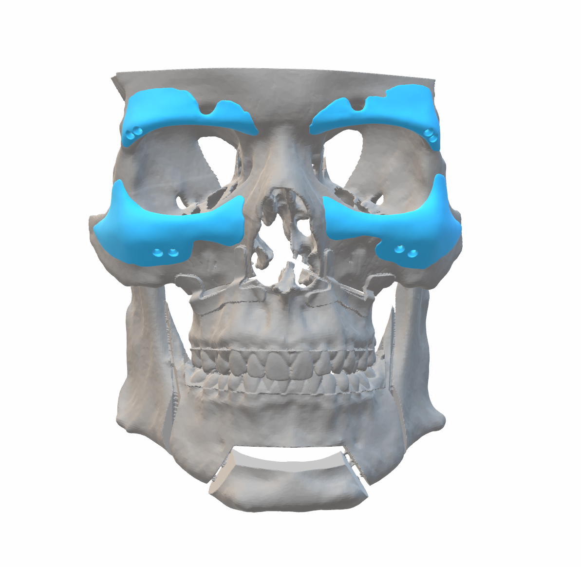 3311458_implants1.png