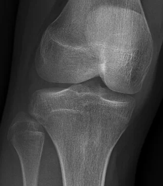 6665043_knee_2.webp