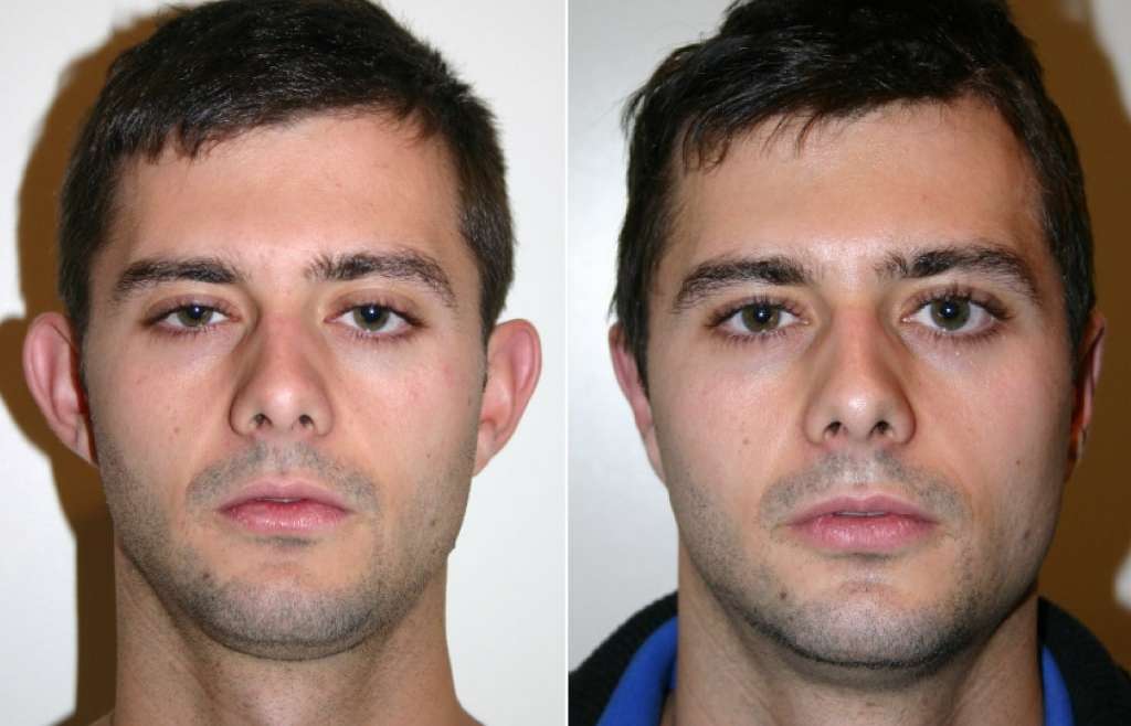 6-Otoplasty-1024x658.jpg