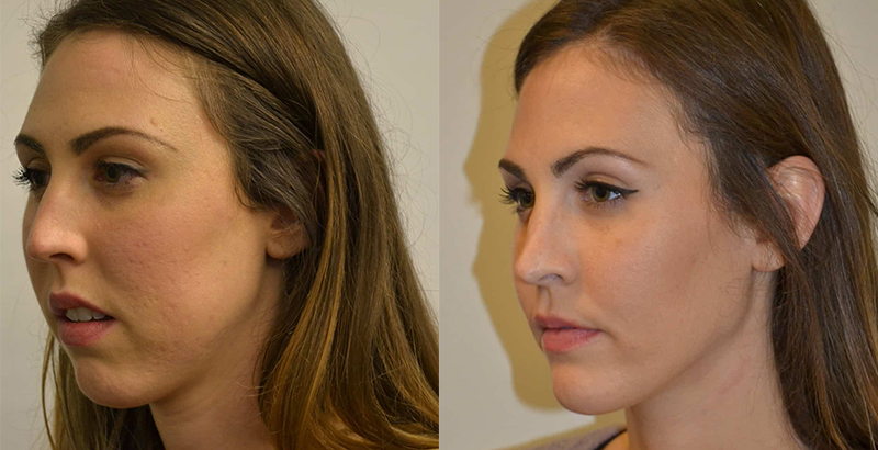 before-after-orthognathic-surgery-aspire-surgical-1.jpg
