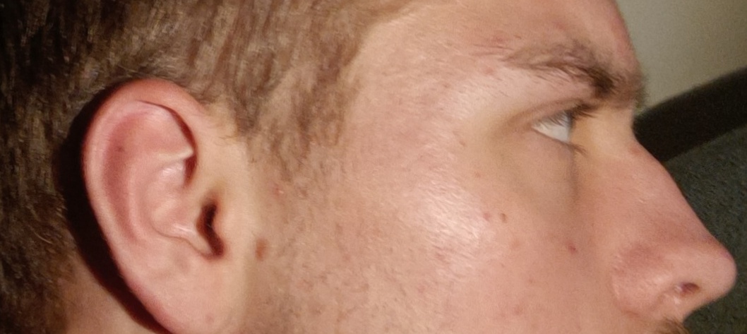 Are my infras recessed? | Looksmax.org - Men's Self-Improvement & Aesthetics