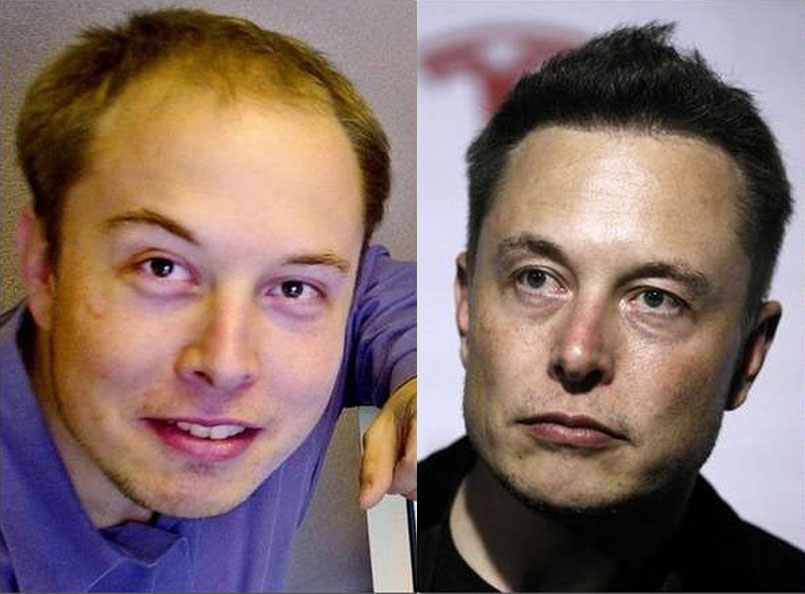 Elon Musk's Hair Transplant | Toronto Hair Transplant Centre