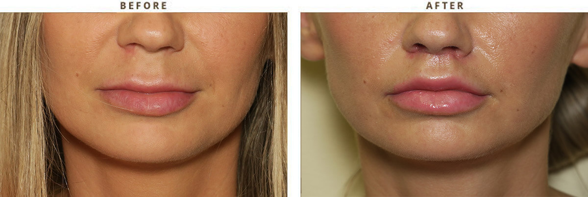 lip-lift-before-and-after-pictures-0018.jpg