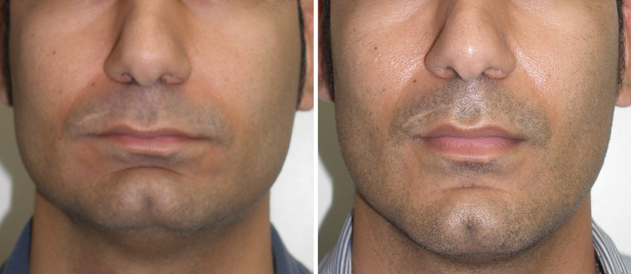 Genioplasty Richmond VA | Chin Implant | Chin Augmentation Midlothian