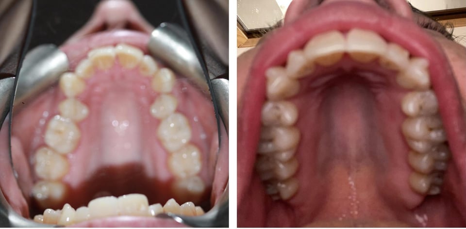 r/Invisalign - a close - up of a person's mouth