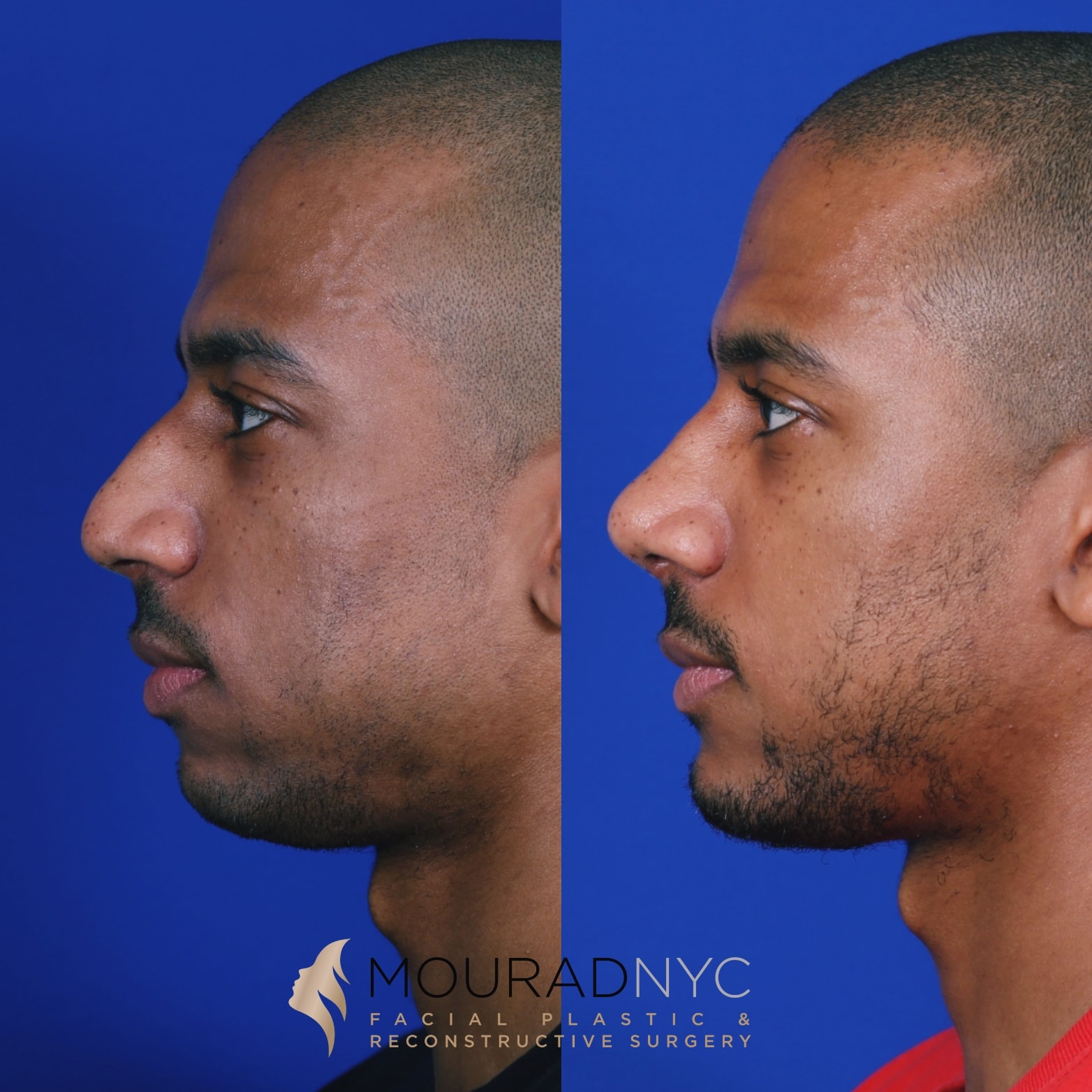 Sliding-Genioplasty-and-Rhinoplasty-Before-and-After.jpg